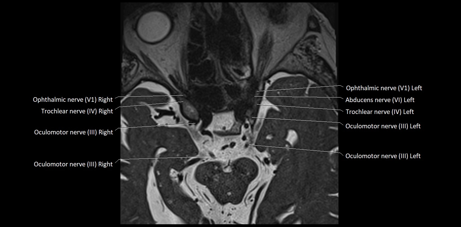 Cranial nerve anatomy axial MRI 3T image 21.webp